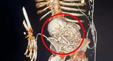 KARNINDA ÖLÜ BEBEKLE 56 YIL YAŞADI